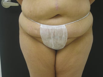 Tummy Tuck After Gastric Bypass before 523251