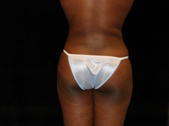 Liposuction of Abdomen, Waist, Flanks and Dorsal Roll after 203520