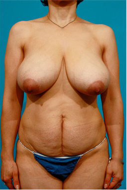 Tummy Tuck and Breast Reduction before 73740