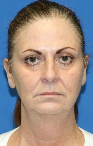 Facelift, Fat Transfer, Upper Bleph, Lower Eyelid Skin Pinch before 424181