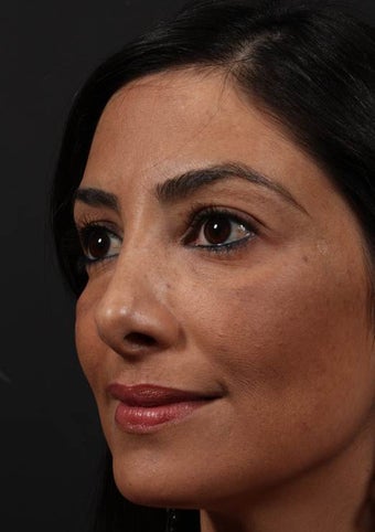 Facial fat grafting after 514131
