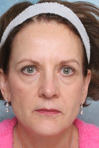 Undereye Deepfill Restylane® and Perioral Perlane® before 119379