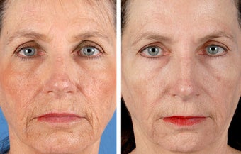 Active FX Fractional Laser Resurfacing before 254010