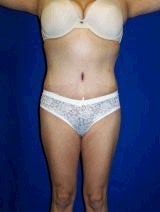 Extended Tummy Tuck Surgery after 147805