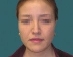 Nose Surgery -Rhinoplasty before 519261
