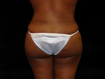 Brazilian Buttocks Lift after 246896