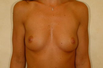 Breast Augmentation before 84870