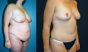 Breast Lift, Tummy Tuck and Liposuction before 350985