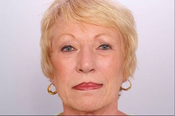 Botox Injection after 253128