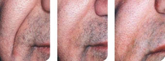 Artefill for nasolabial fold repair before 9595