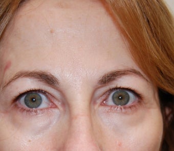 Upper Eyelid Blepharoplasty (Eyelid Lift) before 102881