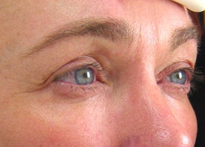 Ultherapy after 520618