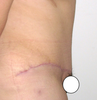 Tummy Tuck (Abdominoplasty) 142536