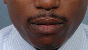 Cheiloplasty before 352432
