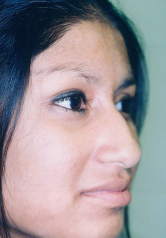Rhinoplasty before 263624