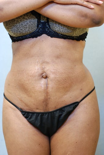 SmartLipo after 356692