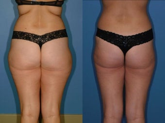 Liposuction - Hips and Thighs after 131866