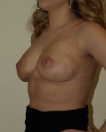 Goes Mastopexy after 228230