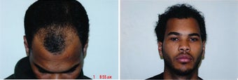 DIFF ANGLES - Hair Transplant before 428531