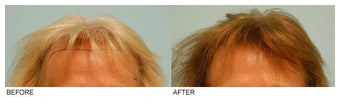 Female Hair Transplant before 134759