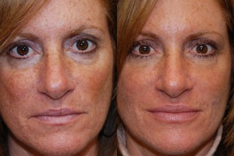 Liquid Face Lift, Non-Surgical Facial Rejuvenation before 134164