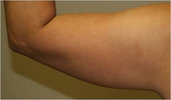 SmartLipo Arm - Left Before before 109324