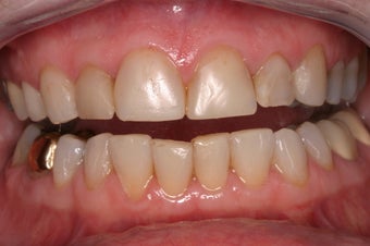 Full Mouth Reconstruction before 329922