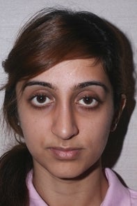 Asian Rhinoplasty after 448659