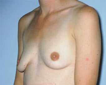 Breast Lift before 285336