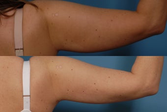 Smartlipo before 409387