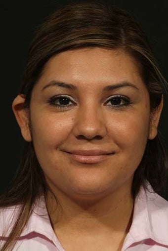 Otoplasty before 292474