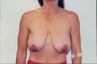 Breast Lift before 218956