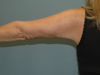 Liposuction 581446