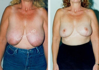Breast Reduction before 243746