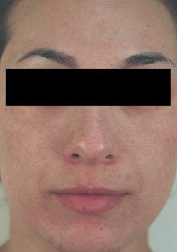 Laser Resurfacing after 89115
