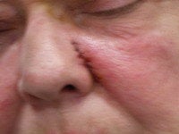 Basal Cell Carcinomas Excisions after 272095