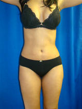 Liposuction after 119486