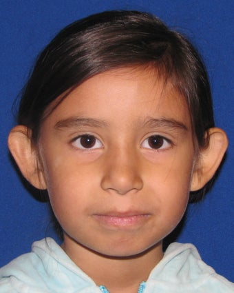 Otoplasty Ear Surgery before 407598
