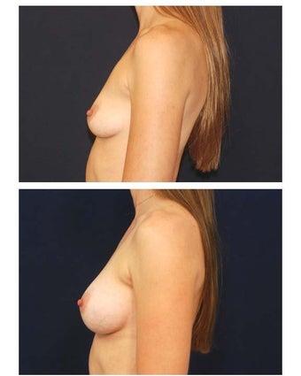 Breast augmentation with silicone breast implants before 54513