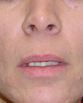Lip Lift before 635441