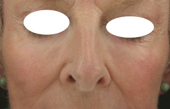 Midface, Cheeks, Tear troughs, and Nasolabial folds treated Restylane and Radiesse after 52828