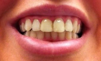 can you eat after zoom whitening