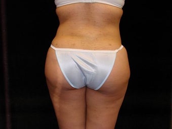 Buttocks Augmentation after 517511