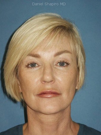 Facelift, Endoscopic Browlift, Upper and Lower Blepharoplasty, Lip Augmentation with Fat injections after 248853
