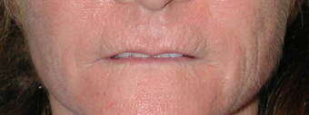 Lip Lift before 624725
