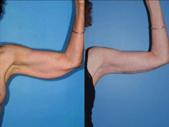 Brachioplasty - Upper Arm Lift after 131872