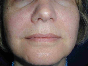 Radiesse treatment after 108821