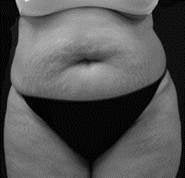 Tummy Tuck, Liposuction before 402480