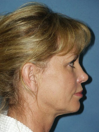 Facelift, Endoscopic Browlift, Chemical Peel to the Lower Eyelids before 248886
