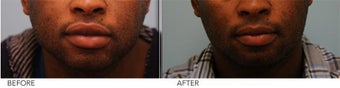 African American Lip Reduction before 421895